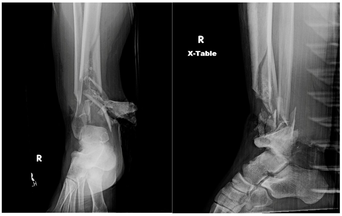 Osteology_MDPI's tweet photo. 🚀 Just published!
“A Comprehensive Review of Bone Remodeling After Trauma and Operative Treatment in Orthopedic Surgery”

in our SI [Advances in Bone and Cartilage Diseases].

🔗https://t.co/vnDOdhtq3X
👉https://t.co/fih3W8yTuZ

#Orthopedics #BoneRemodeling #Trauma #Osteology https://t.co/N5FHWb1DBZ