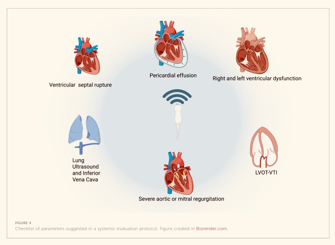 POCUS &amp; IMEST: En shock con ausencia de perfil B, debes sospechar etiología ALTERNATIVA (IAM VD, tamponade pericárdico, TEP masiva).  LUS contribuye no solo al DIAGNÓSTICO, sino a clasificar el FENOTIPO del shock...

frontiersin.org/journals/cardi…