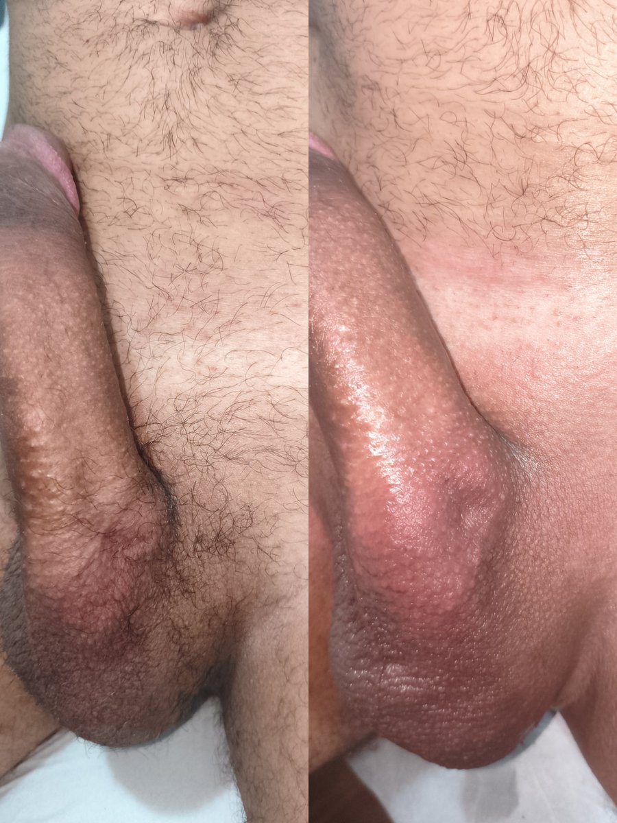 MineiroFlex's tweet photo. O antes e o depois de eu mesmo ter me depilado com cera.
Carnaval chegou e quis ficar lisinho pra curtir

Essa semana foi corrida e nem consegui ir na única pessoa que se dispôs a me depilar 😓 https://t.co/ZjT7LyKKeW