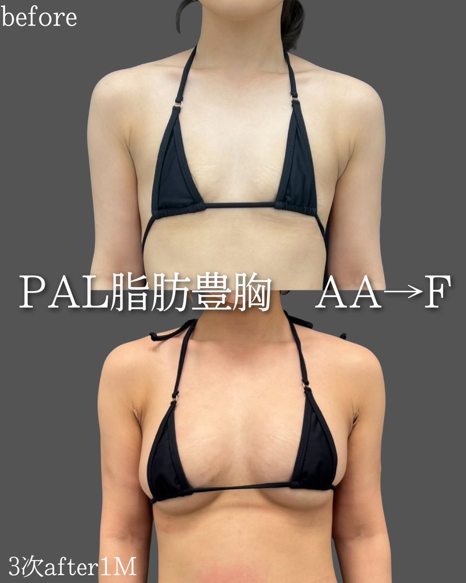 drayakom's tweet photo. 【3次豊胸でAA→F】
1次は土台作り
2次は高さ作り
3次は最終調整

もともとAAと小さめだったため1次の定着は悪かったですが、2次で化けました。
もう少し外乳のラインと丸みを出したいということで3次まで行っています。
寄せたり盛ってないリアルな経過、参考にしてください☺️ https://t.co/dYC6EWJYx2