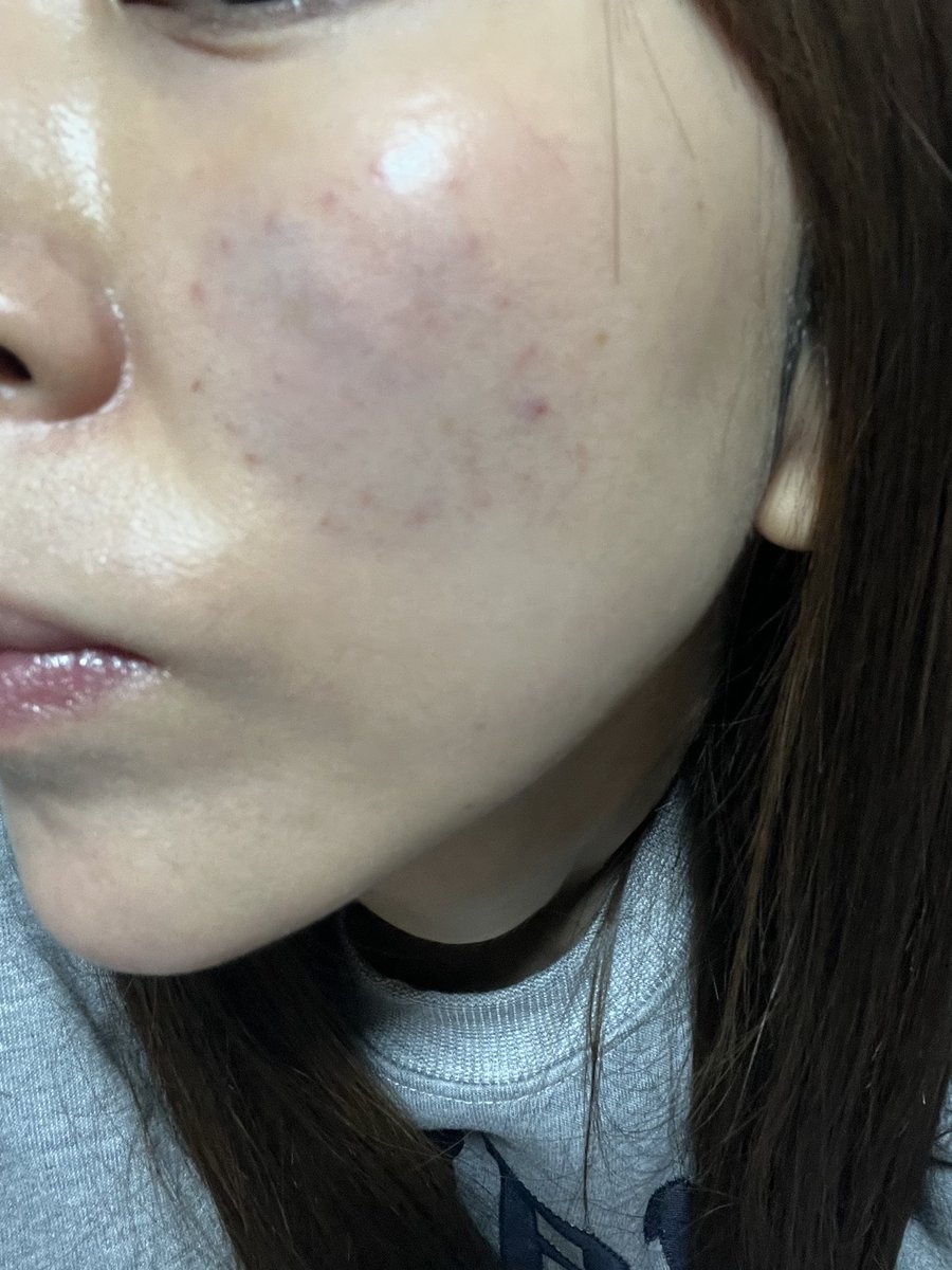 普通のショートスレッドとは違うスプリングコイル状に巻きつけてあるタイプを体験してみた！湘南さんでいううるおいコラーゲンリフト。長いし、痛かったー🤣
ちゃんと内出血してる笑
中顔面のたるみ予防に！ https://t.co/b3nLRZL80h