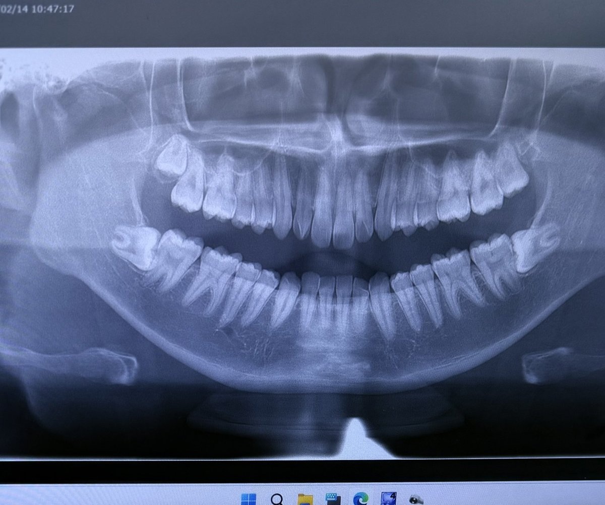 fps_syu's tweet image. 親知らずスヤスヤでワロタ