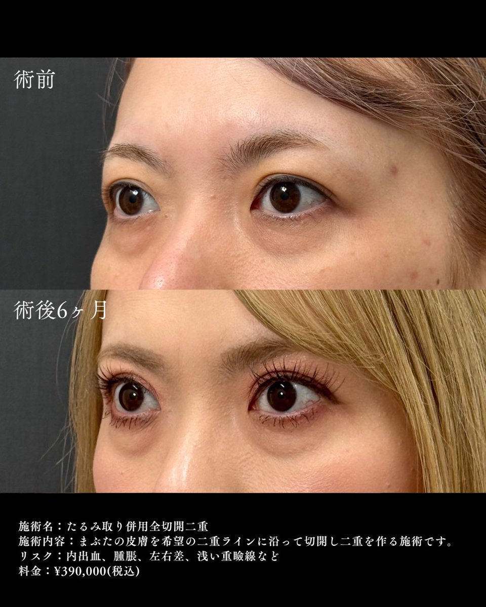 ApollonClinic's tweet photo. 👀たるみ取り併用全切開二重
瞼のたるみとぼやけた二重ラインを同時に治療することで目の開きを良くし若々しい印象に✨ https://t.co/X8nVHhet7V