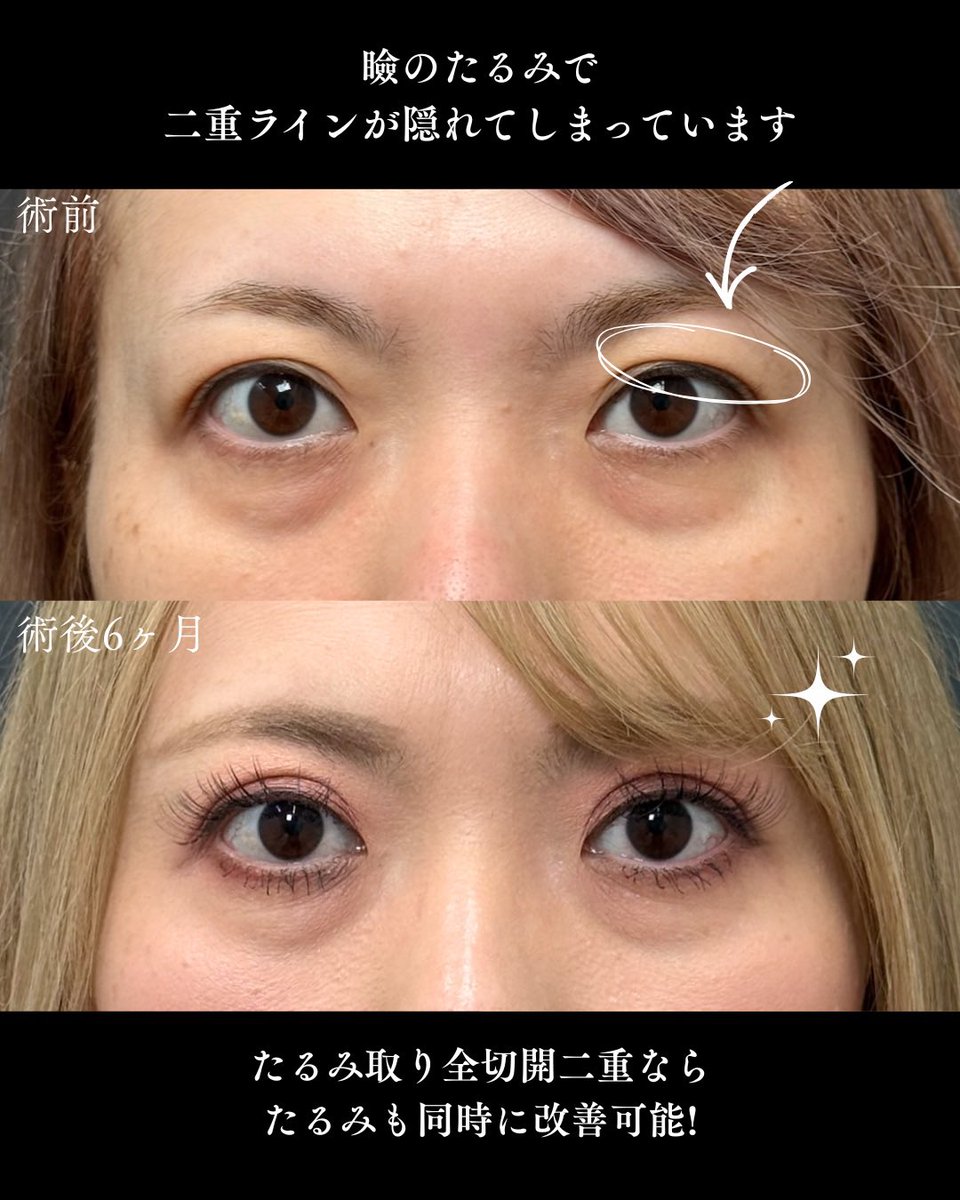 ApollonClinic's tweet photo. 👀たるみ取り併用全切開二重
瞼のたるみとぼやけた二重ラインを同時に治療することで目の開きを良くし若々しい印象に✨ https://t.co/X8nVHhet7V