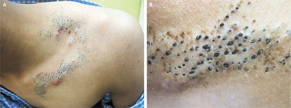 19-year-old male

• Congenital  follicular openings on the left clavicle and upper back 
• Plugged with dark keratinous debris in a linear distribution with subtle background dyspigmentation 👇

👉 What is the diagnosis

Credit: NEJM