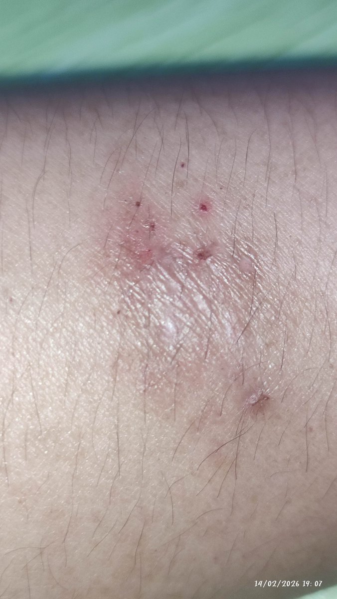 Baru liatin ke dokter, belum cerita ini itu, langsung ditembak "lagi stress ya? "... Ternyata hasil analisa sendiri kemarin itu benar. Ini efek stress🤣. Gatal dan menebal tanpa sebab. Dulu kukira stress ga sampe bikin kelainan pd kulit.