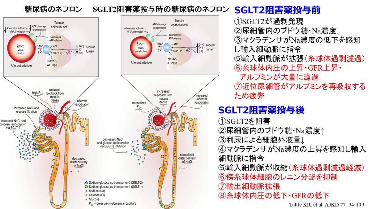 Jun_Hirosena's tweet photo. SGLT2阻害薬の臨床効果、作用機序についてまとめてみた
① SGLT2阻害薬は尿細管糸球体フィードバックを介した輸入細動脈の収縮による糸球体過剰濾過の改善によるアルブミン尿の軽減が主要な腎保護作用の中核をなす
② SGLT2阻害薬にはNa利尿・糖利尿作用はあるが、投与初期のみに認められ、体液恒常性の設定点がやや低めに保たれるので、長期的にも脱水が起こることがありうる
③ SGLT2阻害薬は急性腎障害を25％有意に防ぐことが証明されている
④ SGLT2阻害薬は腎機能が低下しても有害反応を起こさない。ただし効き目は若干、弱くなると思われる。そのため「腎機能低下時に投与しない」というのは有害反応に対する懸念ではなく効果減弱への懸念である
⑤ ただし、SGLT2阻害薬には初期の腎機能低下（initial dip）がある。Initial dipが強力で30％以上のeGFRの低下が認められた場合にはSGLT2阻害薬の中止を考える前に脱水・利尿薬過量・RAAS阻害薬など可逆要因を評価し是正する
⑥ SGLT2阻害薬は糖尿病関連腎臓病（DKD）患者だけでなく、非糖尿病CKDにも有効であり、透析導入を約40％低下できる。また駆出率が低下した心不全HFrEFの心不全入院を30％低下できるだけでなく、駆出率の保たれた心不全HFpEFにも明らかな有効性を示した唯一の慢性心不全治療薬である
⑦ SGLT2阻害薬の作用メカニズムとして、現在はケトン体産生亢進作用とそれに伴う心筋エネルギー代謝改善作用、ミトコンドリア機能改善など、貧血改善作用、尿酸低下作用、炎症・酸化ストレス・線維化抑制作用、体重減少、脂肪肝改善作用などの多様なメカニズムが考えられている。いまだに、どれが主作用なのかは明確ではない