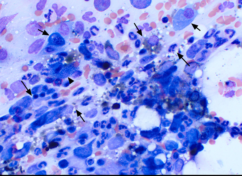 eClinPathCU's tweet photo. Pure red cell aplasia in a dog: Fibrosis is supported by streaming of the cells (long arrows). There was a plasmacytosis (short arrows), including Mott cells (arrowhead) and increased marrow iron. All of these findings can be features of this syndrome. https://t.co/Df21EkBiiK