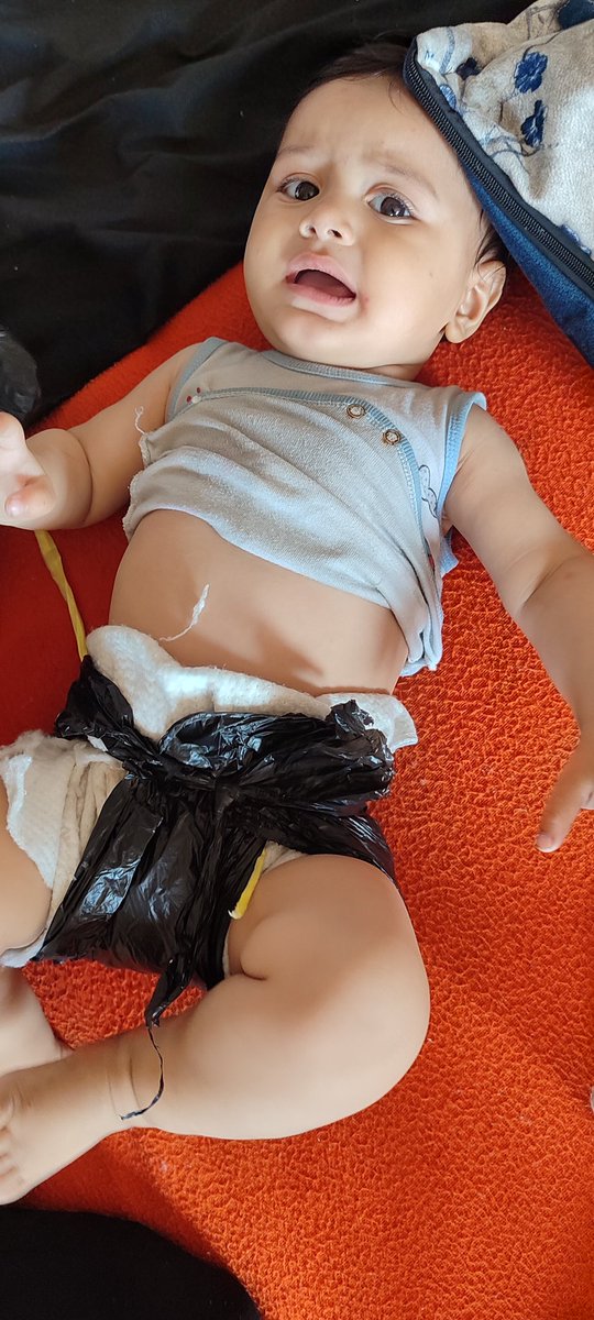 My young child has a skin allergy

Look at my baby! I use nylon instead of diapers because I don't have the money to buy diapers, and after using nylon, he developed an allergic reaction and severe redness.

I want to buy diapers and a can of milk. Can you help me? 

Donate,