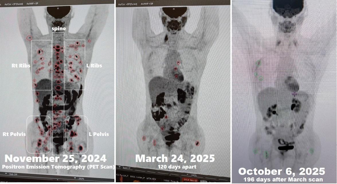 ChicagoERDad's tweet photo. Now that you’ve seen the corruption that the system thrives on, I hope you will look deeper into diagnosis and treatments that are also rife with corruption. This is my friend who I helped counsel using diet, lifestyle and repurposed medication to defeat stage IV metastatic breast cancer in under a year.  I have no illusions that she is completely cured but this is miraculous.