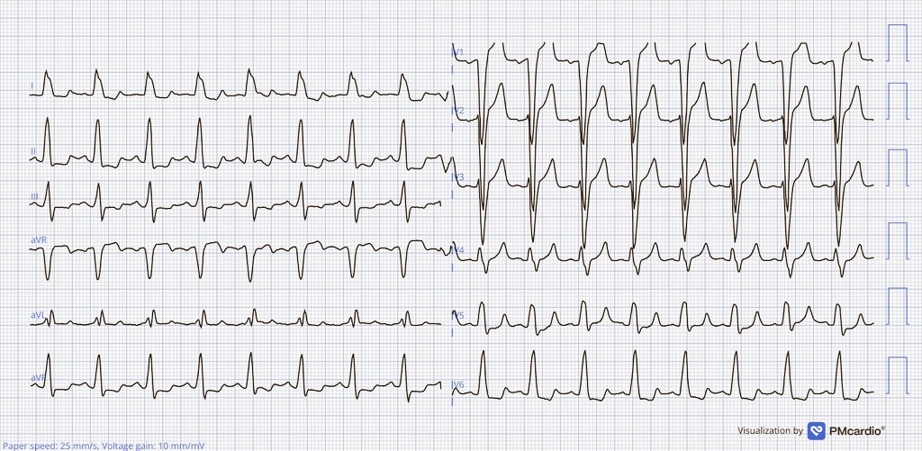 61 y/o F with palpitations
Right Ecg after 6mg Adenosine
What will explain the different Qrs morphology in WCT?

<a href="/ALFIEEP1/">ALBERTO ALFIE</a> <a href="/SergioPinski/">Sergio Pinski</a> <a href="/syamkumarmd/">Syamkumar</a> <a href="/narrowQRS/">JMC</a> <a href="/DaveRichley/">Dave Richley</a> <a href="/ProfDConnelly/">Derek Connelly</a>
<a href="/melhamriti/">El Hamriti Mustapha</a> <a href="/Hapa_EP/">Kevin Brady</a> <a href="/Willis_Kwandou/">Willis Kwandou</a> <a href="/Arron_Pearce_/">Arron Pearce</a> <a href="/GusCostaEP57/">Gustavo Costa</a> 
#epeeps #ecg
