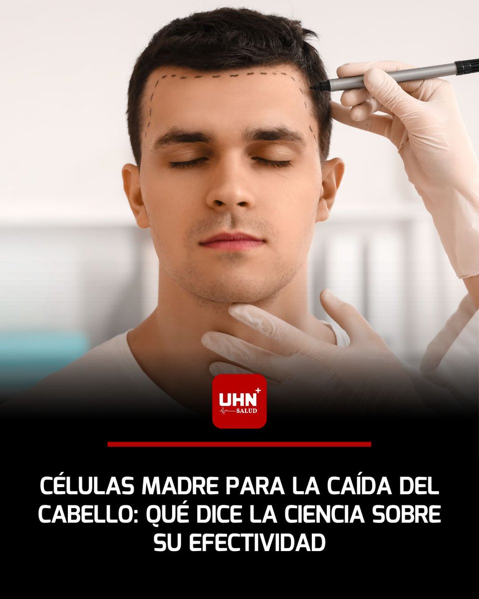 🩺‼️ | El uso de células madre como tratamiento contra la alopecia genera cada vez más interés en el ámbito médico y estético. Según especialistas citados por Infobae, esta estrategia busca estimular los folículos pilosos mediante factores de crecimiento derivados de células