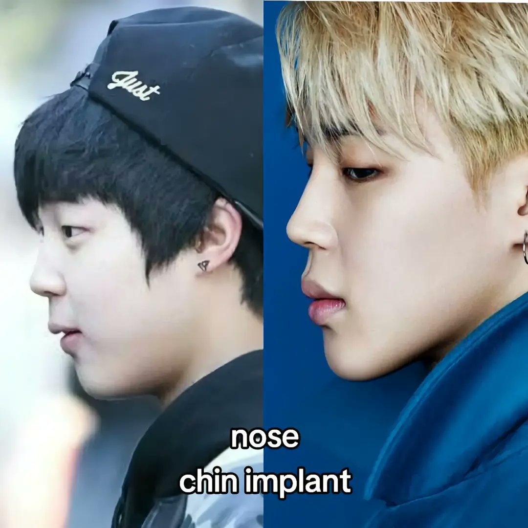 hidden0truths's tweet image. Bts member jimin has done nose and chin jawline surgery.