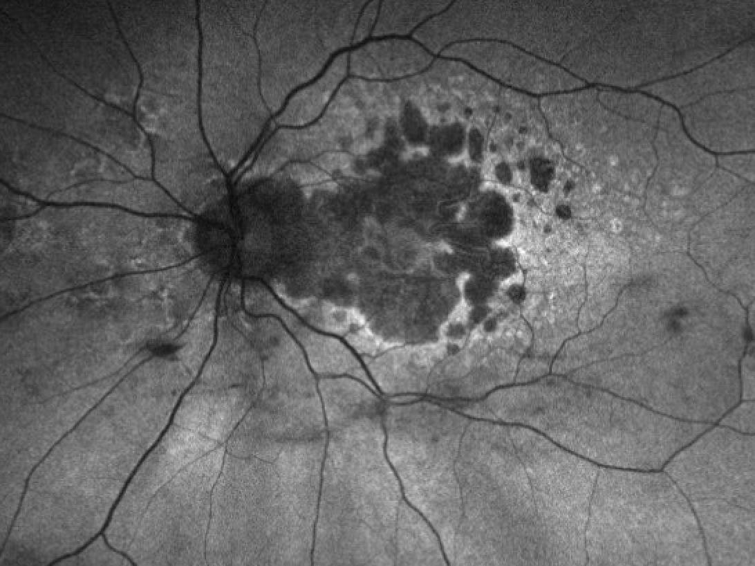 RetinaSociety's tweet photo. Geographic atrophy being treated with complement inhibition. https://t.co/gY65oMOWml