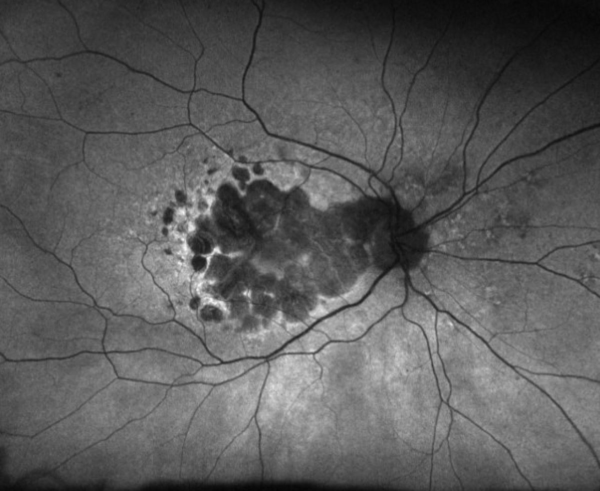 RetinaSociety's tweet photo. Geographic atrophy being treated with complement inhibition. https://t.co/gY65oMOWml