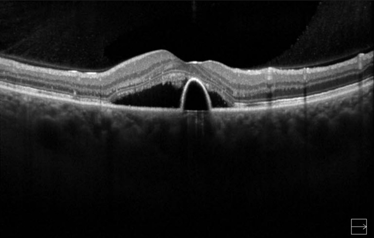RetinaSociety's tweet photo. Central serous chorioretinopathy. There is a markedly thick choroid in this woman in her 30's on oral prednisone. https://t.co/RbgzJZIm9t