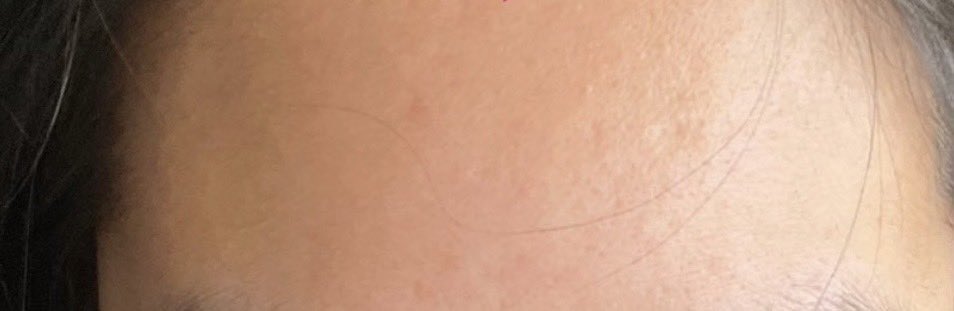 4amvanila's tweet image. คอนเฟิร์มอีกรอบว่าอันนี้สิวหายจริง จางลงทั้งรอยแดง+รอยดำ เป็นวิตามินที่กินแล้วรู้สึกเห็นผลดี แล้วไวอะ หน้าใสขึ้น x300% ผิวแข็งแรงขึ้นดีด้วย ราคานร.