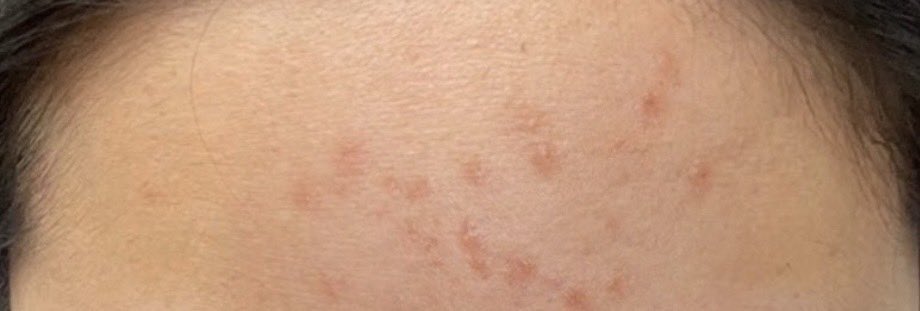 4amvanila's tweet image. คอนเฟิร์มอีกรอบว่าอันนี้สิวหายจริง จางลงทั้งรอยแดง+รอยดำ เป็นวิตามินที่กินแล้วรู้สึกเห็นผลดี แล้วไวอะ หน้าใสขึ้น x300% ผิวแข็งแรงขึ้นดีด้วย ราคานร.