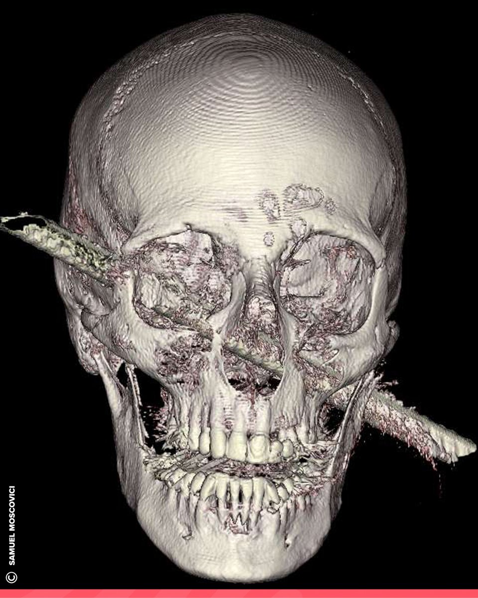 BigBangSciCom's tweet photo. Le crâne de Kamel Abdel Rahman, transpercé par une tige métallique de 50 cm, pile entre 2 artères. Opéré avec succès, il a survécu et a pu renter chez lui 3 semaines plus tard !

Crédits : HADASSAH SPOKESPERSON
https://t.co/l34WxyNnIy

#Médecine #Anatomie #CorpsHumain #Imagerie https://t.co/I4RNUnPRD4
