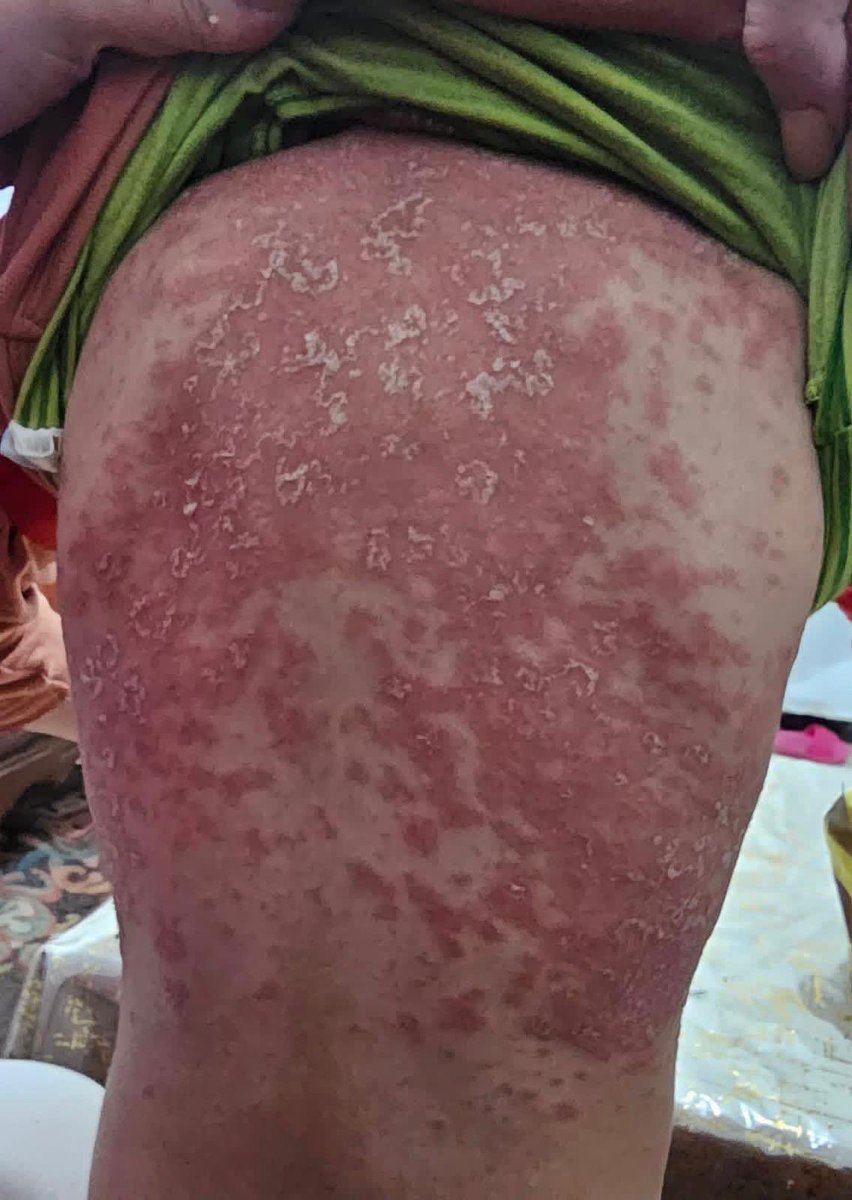 Dr_SaebGaza's tweet image. My sister’s health condition has been noticeably worsening these days. Please keep her in your prayers for a speedy recovery.