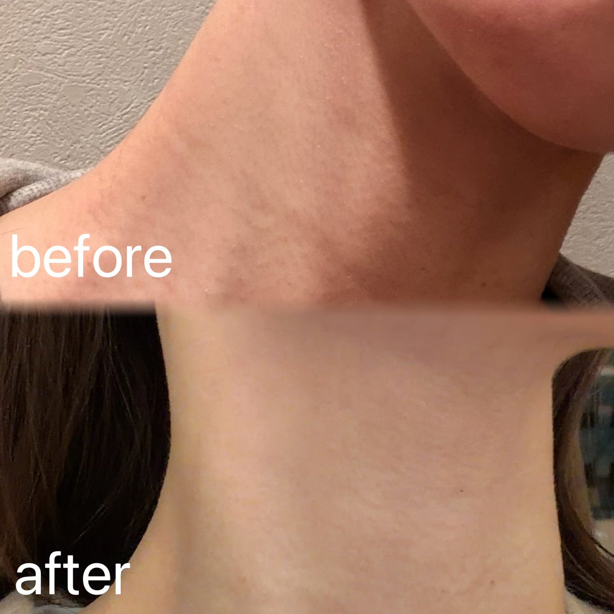 pukupukusandesu's tweet image. 小田切ヒロおすすめの話題の首元ケアアイテム、MEDIPEELのプレミアムネッククリーム＆ネックスティックほんとに効果ありすぎた。今まで顔だけケアして首放置してたけど、「首までが顔」て痛感！早めにケアし始めてまじでよかった。【PR】#メディピール #MEDIPEEL