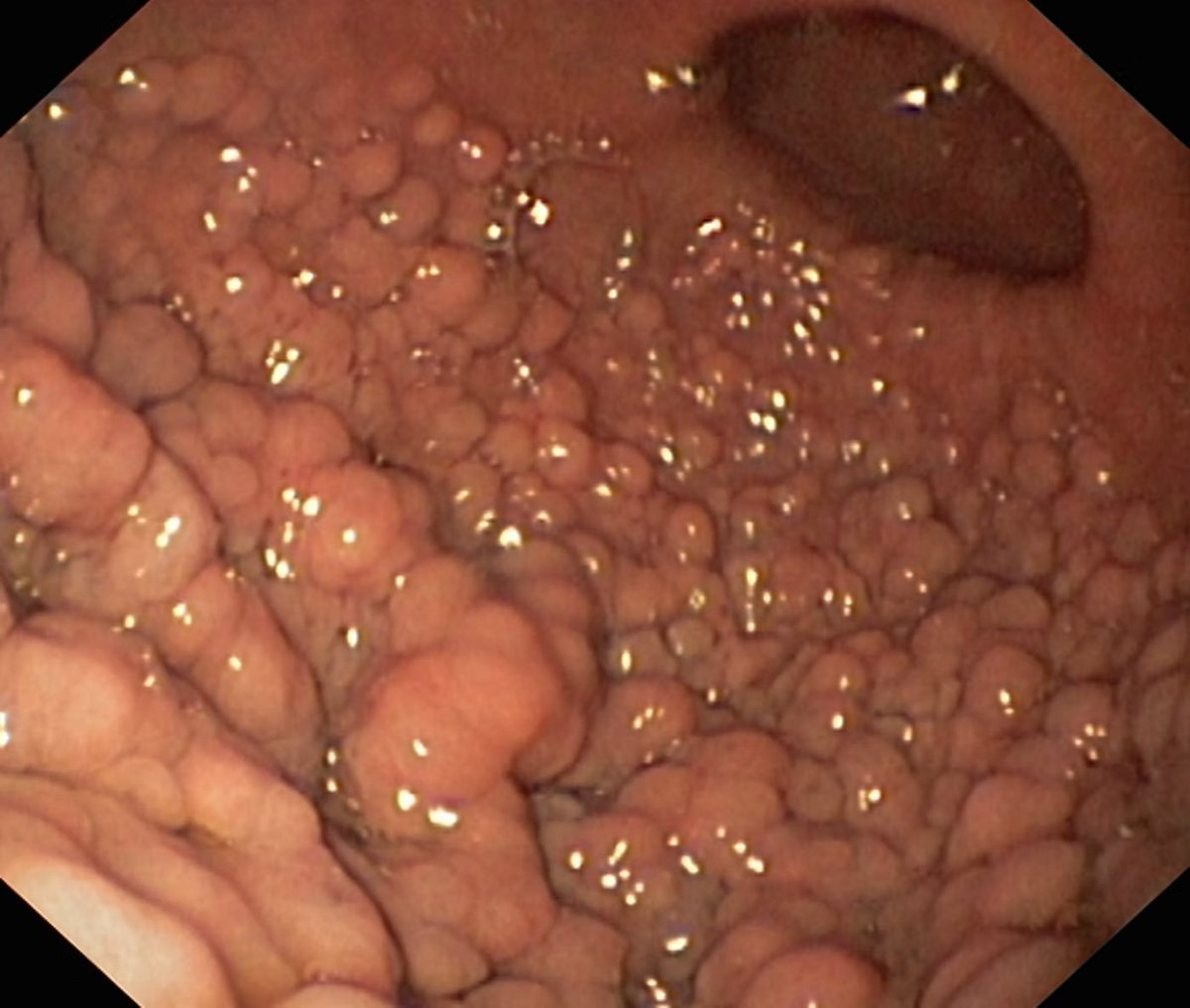 EndoCollab™ | GI Endoscopy Community tweet media