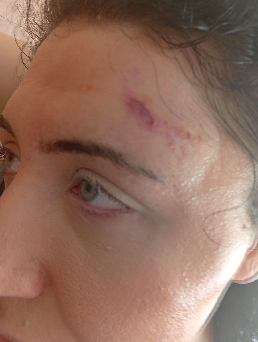 Herkese merhaba dün gece korkunç bir olay yaşadık. Yakın bir akrabamız yaklaşık 1 ay önce evlendiği eşi tarafından ağır darp edildi. Bizi arayıp öldürüyor yardım edin dediğinde öğrenip hemen koştuk ancak bununla bitmedi. Eşinin daha önce cinayetten hüküm giydiğini öğrendik++