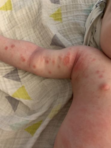 Rozana_0l's tweet photo. The rash isn't just on his chest; it covers his entire body.

Please pray for his speedy recovery. 🙏🏻🙏🏻

https://t.co/uvrI7UrhsQ https://t.co/GcU9XAD8ky