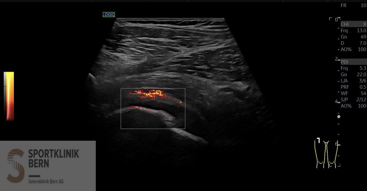 SportklinikBern's tweet photo. Arthrosis of the hip with #ultrasoundguidedinjection with #arthrexprp and #ostenilplus - #mskus #pocus pocushub GElogiqE10sr4 https://t.co/waKovcRVg4