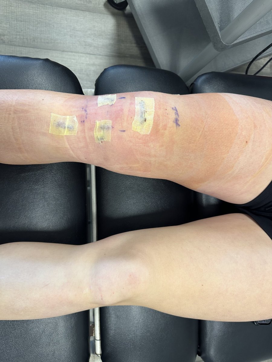 EllaMoss2027's tweet photo. Had surgery to repair my ACL on 2/10. First PT session was 2/13.  Ready for the next session. Thanks to everybody that reached out and all the well wishes. 
“No comeback without a setback” Thanks Roy Gilmore. @TGNatGroves @ChrisDuerr @topgunfastpitch https://t.co/wEvJ86e4uK