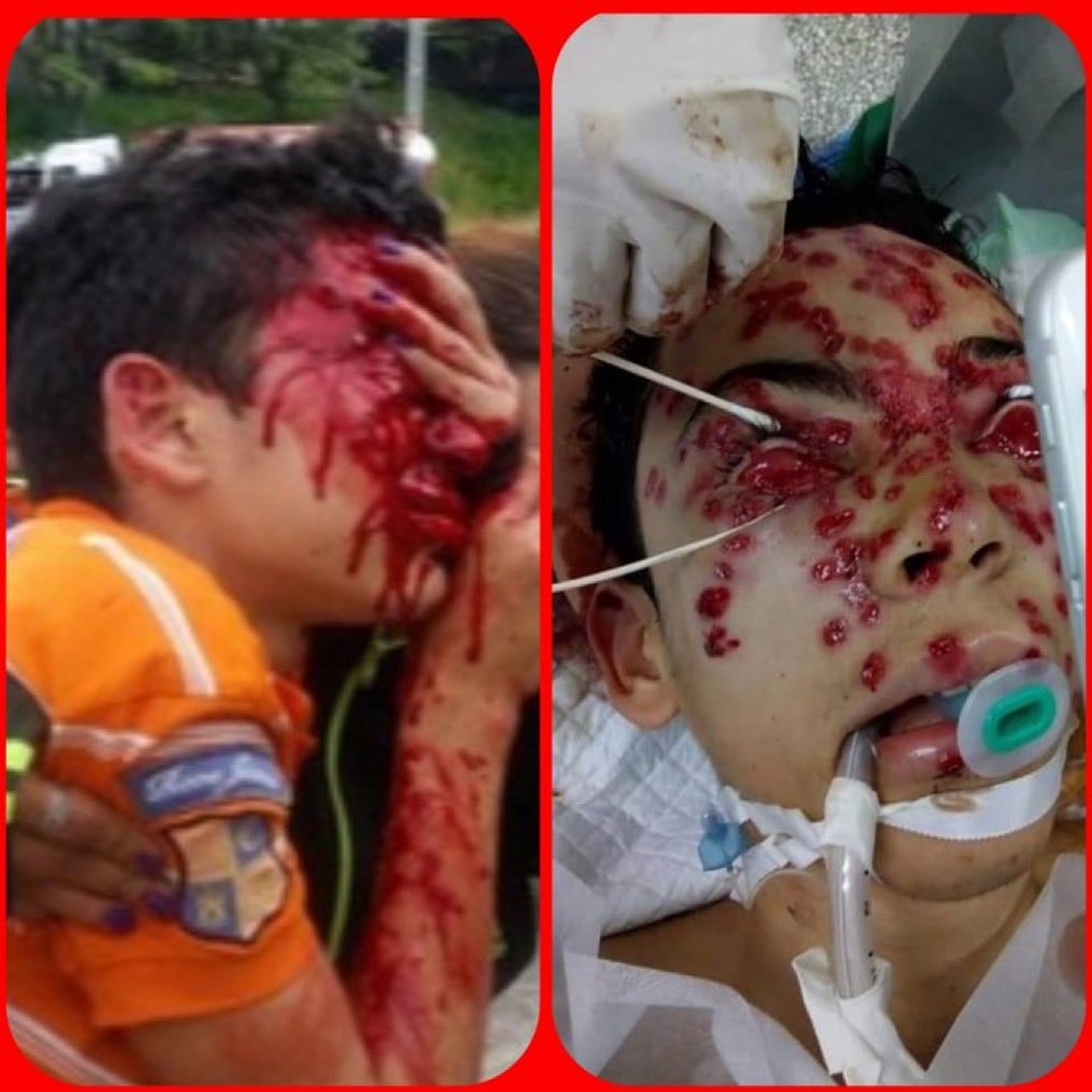 Para los ZURDOS ,que quieren soltar al NARCO-DICTADOR ASESINO NICOLÁS MADURO ! Recuerden que El le hizo esto a los jóvenes Venezolanos 👇🏼👇🏼