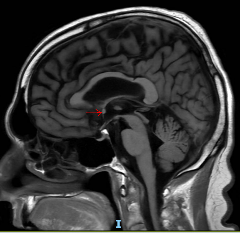 The red arrow highlights a subtle rounded prominence along the anterior ...