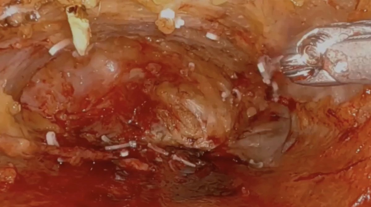 MUSC Urologic Oncology Program tweet media