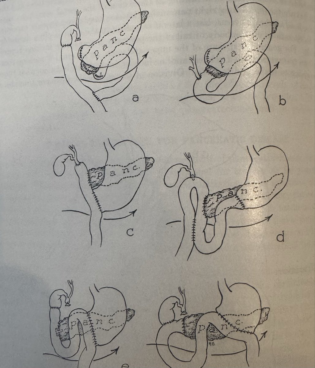 SyedAAhmad5's tweet photo. Description of pancreatic surgery. Circa 1953.  @juliomayol @TomVargheseJr https://t.co/XFPvFV2EVF