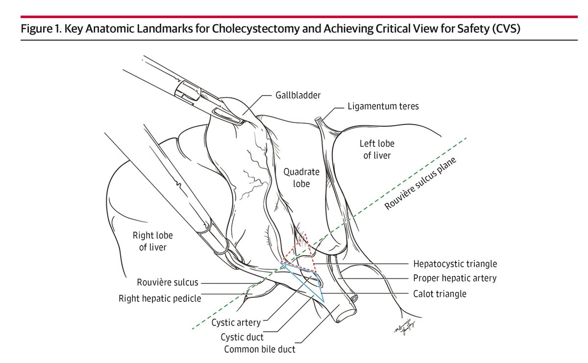 JAMASurgery's tweet photo. This Review highlights that difficult cholecystectomies are associated with distinct patient, disease, and imaging factors, and emphasizes the need for careful assessment, advanced imaging, and adaptable surgical strategies to prevent serious injuries. https://t.co/bkvdvMnuGu https://t.co/pkEZc7FISZ