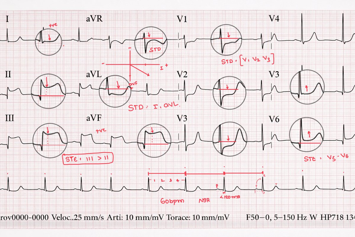 Dr_Shiv_kumar_'s tweet photo. Breakdown of this ECG : 

What the ECG Shows

✅ Inferior STEMI
       STE in II, III, aVF
Reciprocal ST depression in I, aVL
STE in III > II → favors RCA over LCx

✅ Posterior Wall Involvement
ST depression in V1–V3
Tall R waves in V1–V2 (posterior Q equivalent)

👉 This = posterior extension of inferior MI

✅ Lateral ST Elevation (V5–V6)

There is STE in V5–V6

But why? 

So this is not a “pure” inferior MI.

What Pattern Is This?

👉 Infero-posterolateral STEMI

Now the key question:

If RCA is culprit, why lateral wall involved here ?

The Explanation :- 

It depends on coronary dominance.
In a dominant RCA. 

RCA supplies:
▶️Inferior wall
▶️Posterior wall (via PDA)
▶️Sometimes posterolateral branches

If the occlusion is:
👉 Proximal RCA before the posterolateral branch

Then you get:
Inferior STE
Posterior STD (V1–V3)
Lateral STE (V5–V6)

So lateral wall involvement can still be RCA especially in a dominant system.

Now look at aVR, it seems like there is ST depression is there?

What does it signifies?

In the setting of:
STE in II, III, aVF
Reciprocal STD in I, aVL
Posterior involvement

👉 ST depression in aVR usually reflects transmural inferior injury vector directed away from aVR.

#MedTwitter #MedX #ECG #cardiology