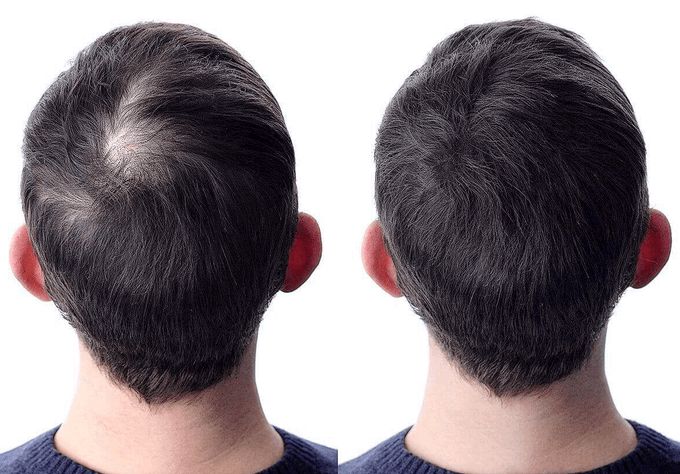 VargasKevi70887's tweet photo. Tu cabello se está debilitando debido a la edad, pero en realidad es una DEFICIENCIA DE NUTRIENTES, ¿y sabes qué? Es reversible.

La industria de 13.900 millones de dólares prefiere venderte champú. Pero la verdadera solución está en lo que comes.

Esta es la verdad que no quieren que sepas:

- 🧵 -