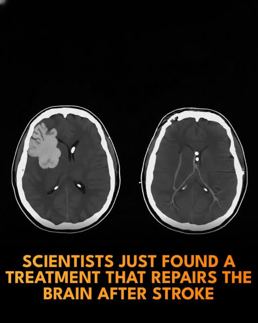 🧠 A new therapy can repair brain damage after stroke.

Scientists at Northwestern University have developed an experimental intravenous (IV) therapy that can help protect and repair the brain after the most common type of stroke. 

In ischemic stroke, a blood clot blocks blood