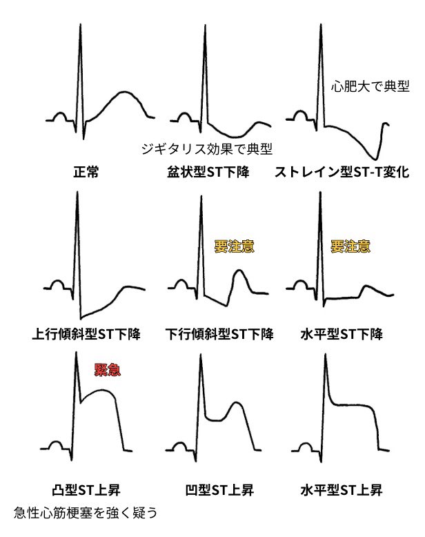 ST変化とは、
J点を基準としたST部分が、
基線から
ズレている状態を指します。

正常では基線と
大きなズレはありません。

そこから上にずれればST上昇、
下にずれればST下降です。

しかし重要なのは「どのようにズレているか」です。

・水平型や下行傾斜型のST低下 → 虚血性心疾患を疑う