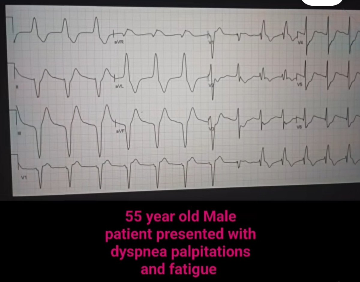 albertoortegana's tweet image. A 55-year-old male patient presents to the emergency department with dyspnea, palpitations, and shortness of breath. The electrocardiogram shows what you see. #cardiology #medical #cardio #Doctor #medicine #echo 
@dr_manish_ydv @Dr_Shiv_kumar_ @DrAkhilX @DrArslan480 @drobiy12