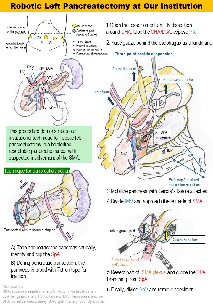 jses_eng's tweet photo. JSES IllustCon 87
📌Robotic Left Pancreatectomy at Our Institution
📝Technical refinements for surgical field exposure in robotic left pancreatectomy for BR-A pancreatic cancer involving the SMA. Our strategy focuses on stable exposure with readiness for emergent conversion.
🖊Mitsui Noriki
#JSESイラストコンテスト　#JSES_illustration_contest