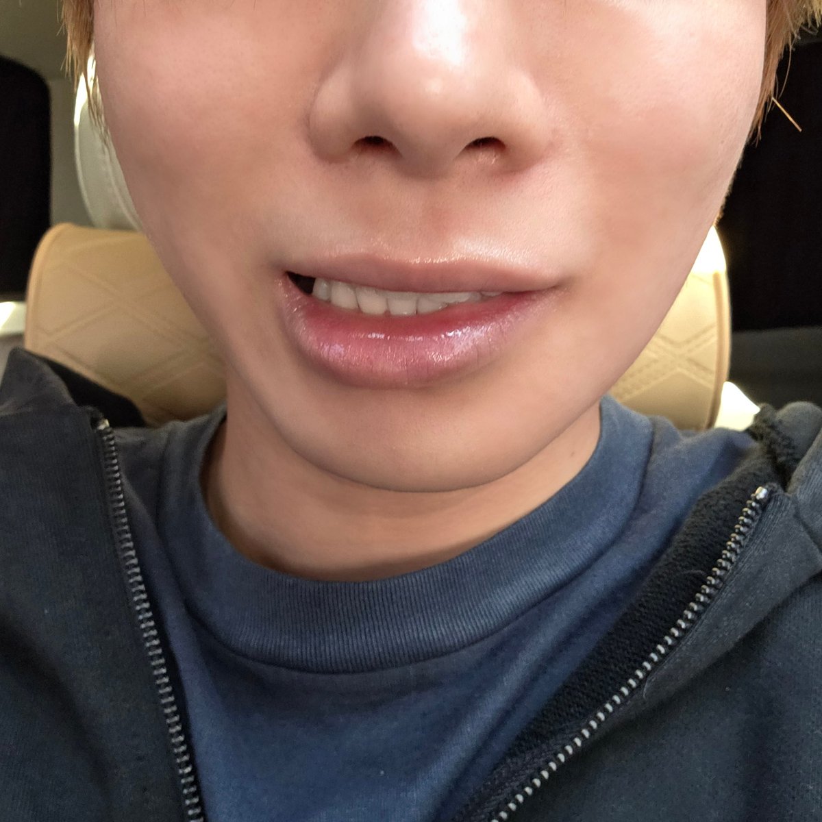 [260216] weverse dm 🐿️🐱💬

🐿️🐱 they gave me anesthesia so one side (of my face) isn’t moving, this is so funny hahahaha
🐿️🐱 i’m genuinely smiling