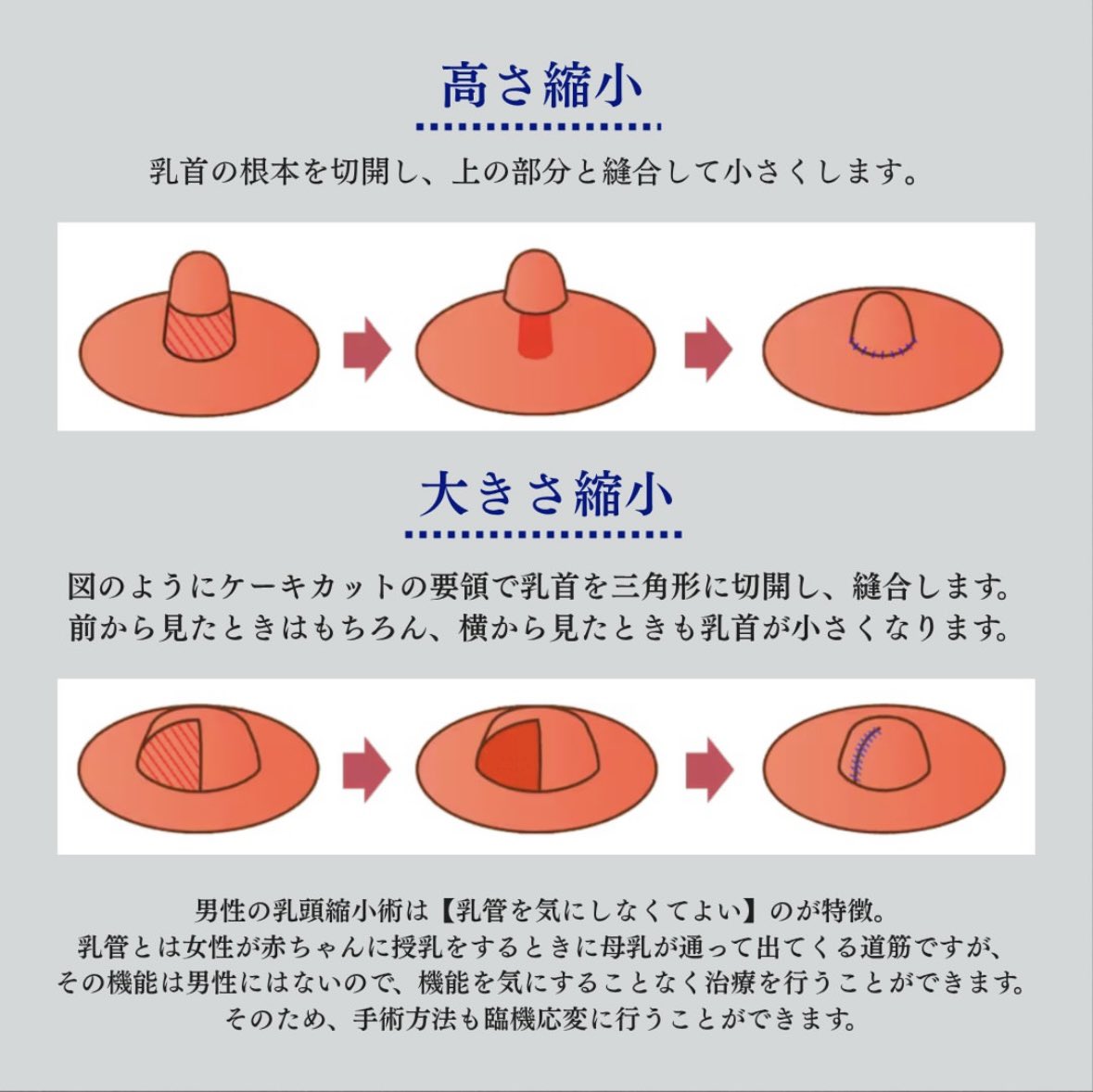 sbc_furusawa's tweet photo. 実は乳頭のお悩みは女性だけではありません！
メンズの"ちくぽこ"問題も乳頭縮小術で半永久的に解決できます。
お悩みの方はぜひご相談ください！
#秘密のママ園2 https://t.co/E7KkWwgUMu