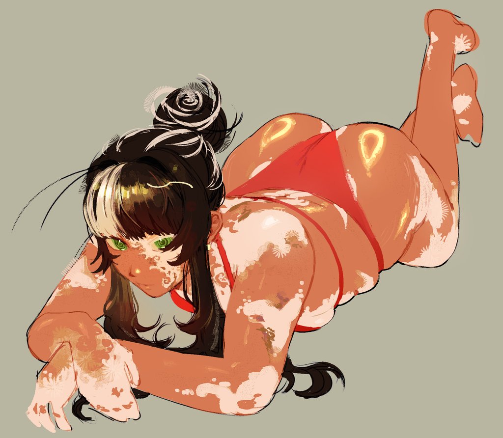 vitiligo is beautiful