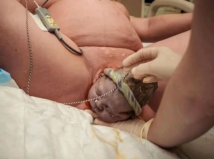 payoo241's tweet image. SPOT THE DIAGNOSIS???

#ObGyn #MedTwitter #PathTwitter