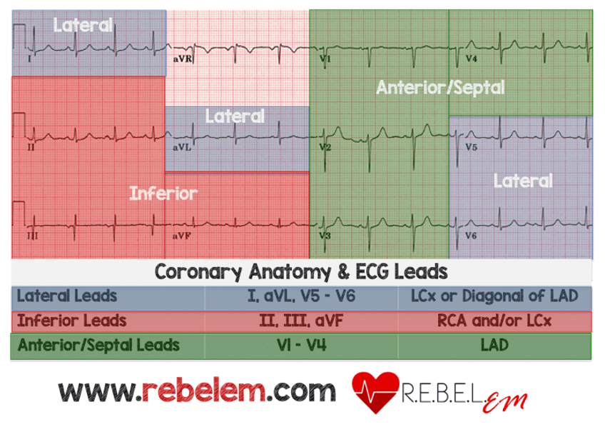 AB_drmd's tweet photo. ✅ال Myocardial infarction ينقسم حسب الـ wall المتأثر إلى أنواع رئيسية وكل نوع له تغيّرات مميّزة في ECG: 
🔷 أولًا Anterior wall MI (يشمل septal و anterior) ويظهر غالبًا ST elevation في leads V1–V4 (وأحيانًا V5–V6 إذا كان واسع)، وهذا يدل على انسداد في Left Anterior Descending artery (LAD).
🔷 ثانيًا Inferior wall MI ويبان فيه ST elevation في leads II, III, aVF وغالبًا يكون سببه انسداد Right Coronary artery (RCA).
🔷 ثالثًا Lateral wall MI ويظهر ST elevation في leads I, aVL, V5, V6 وغالبًا مرتبط بـ Left Circumflex artery (LCX).
🔷 رابعًا Posterior wall MI ما يطلع مباشرة ST elevation لأنه خلفي، لكن نشوف علامات عكسية مثل ST depression مع tall R wave في leads V1–V3 (وكأنه mirror image)، وإذا حطينا posterior leads V7–V9 نشوف ST elevation.
🔷 خامسًا Right ventricular MI غالبًا يجي مع Inferior MI ويظهر ST elevation في lead V1 وخصوصًا في right-sided leads مثل V3R–V4R.