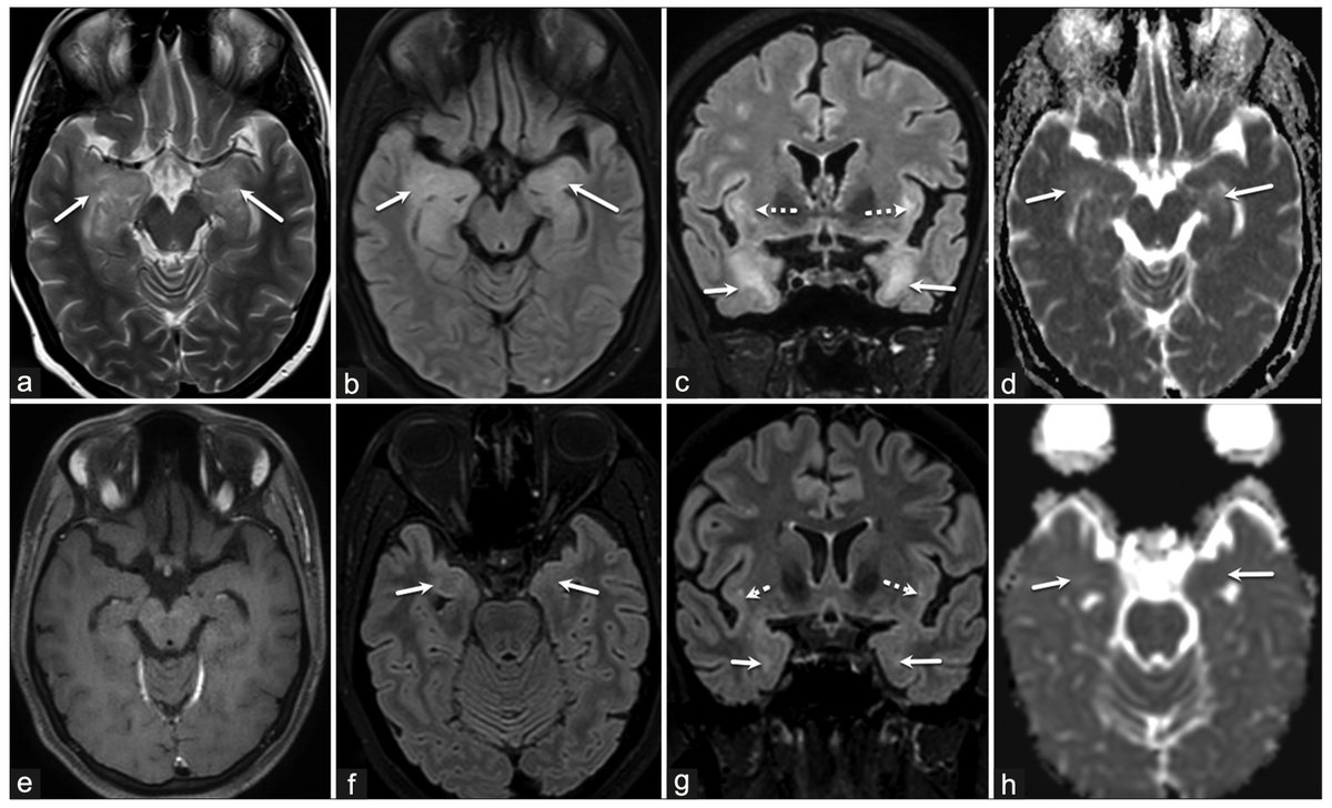 Annals of Indian Academy of Neurology tweet media