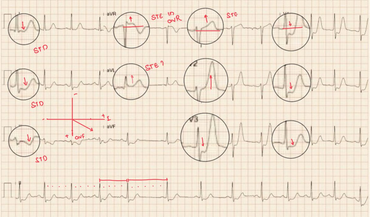 Dx- De winters pattern 

This is De Winter pattern 👉🏻proximal LAD occlusion (STEMI equivalent).
A very high risk ecg, immediate activation of cath lab recommended. 

Breakdown : 
• Up-sloping ST depression at the J-point in V1–V6 
• Tall, symmetric hyperacute T waves in