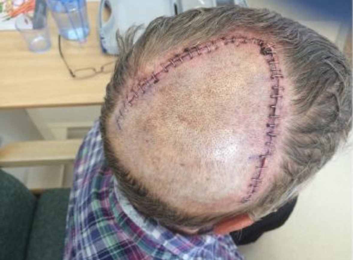 It’s the 9th anniversary of my 🧠 surgery today! 🎉

Still here, all clear and loving life!
#cancersurvivor #braintumour