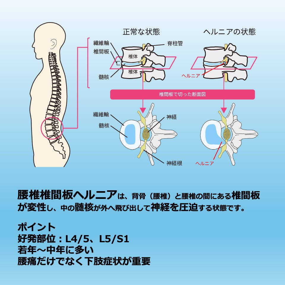 fhu_rehabil's tweet photo. 藤田医科大学リハビリテーション学科です｡

今回は【腰椎ヘルニアの回復過程と運動療法】を特徴と対処法の２回に分けて紹介します！

ヘルニアは日本人を悩ます疾患です｡まずはこの病気の特徴をお伝えします♪

#藤田医科大学
#リハビリテーション学科
#理学療法
#作業療法
#椎間板ヘルニア https://t.co/RPToUWJURf